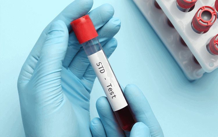 STD test sample